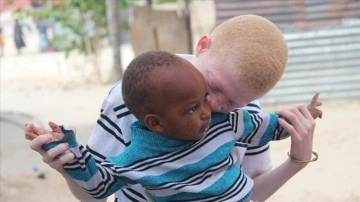 Afrikalı albinolar 'beyaz' ortak doğacak ümidiyle yaşıyor