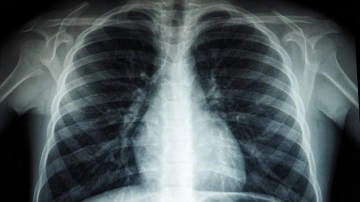 Düşük değerli birlikte ilacın Kovid-19 hastalarında akciğer zararını sınırladığı belirlendi