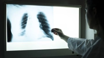Kovid-19 sürecinde dünyada tüberküloz tanılama payı düştü, hastalığa ilişkin ölümler arttı